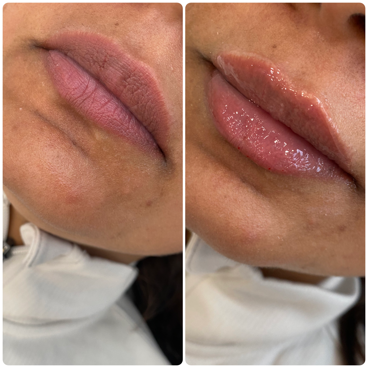 Injectables client results 1