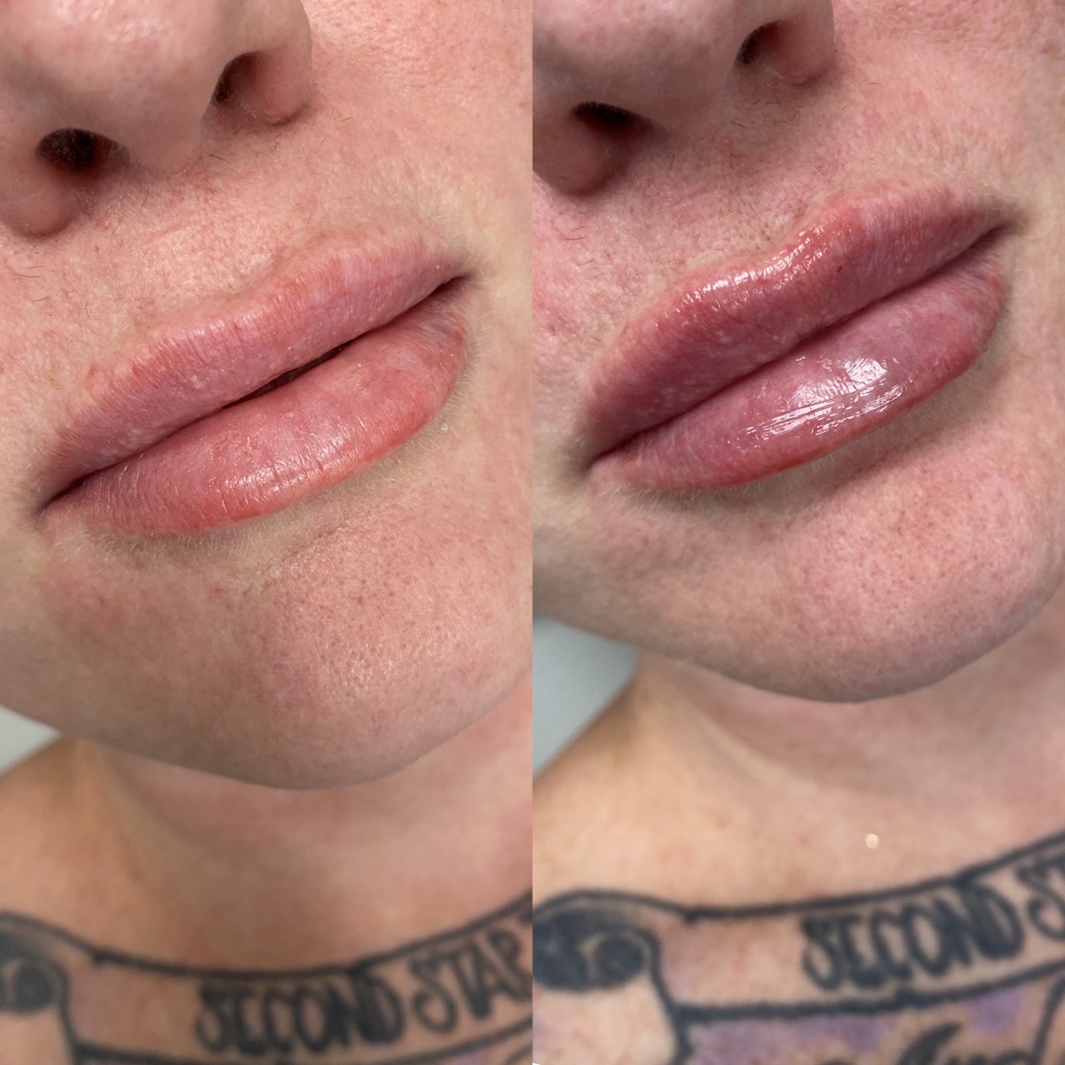 Injectables client results 4