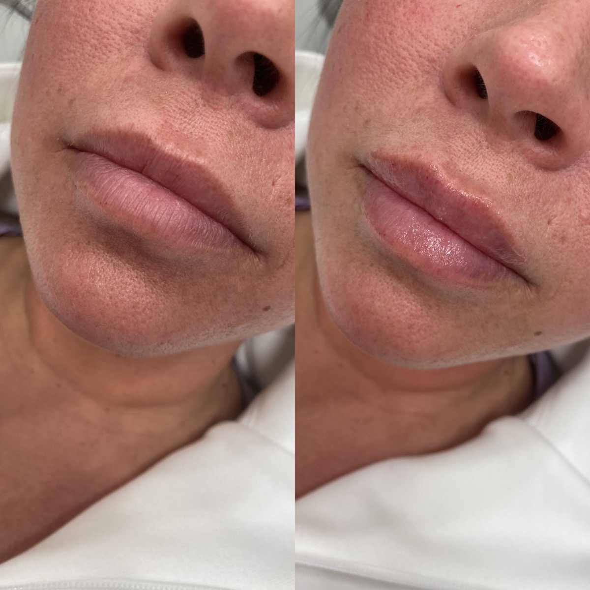Injectables client results 5